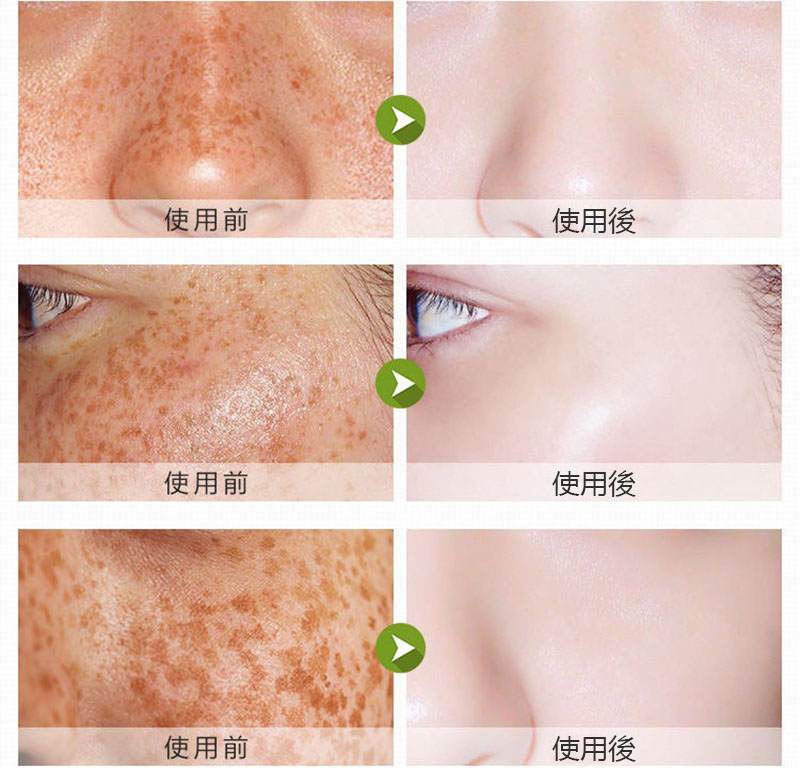 OSUFI Whitening Anti-freckle Essence(২১ টি মেসতা রিমুভার ক্যাপসুল সেট)  thumb 3